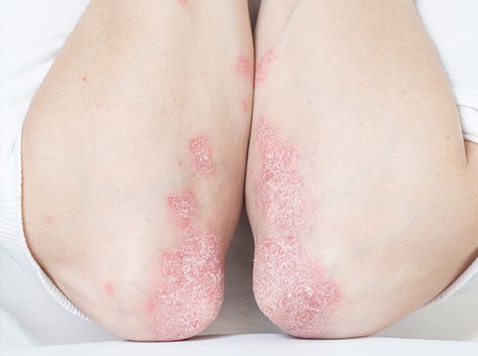 Person Suffering from Psoriatic Arthritis